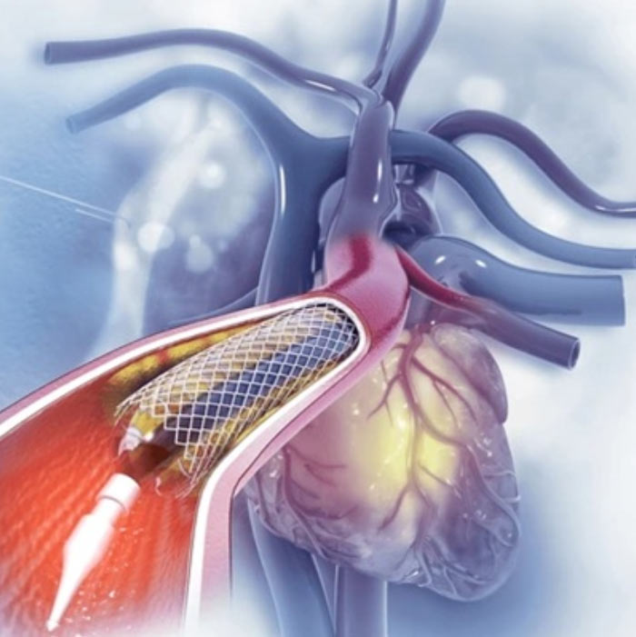 Angiography Doctors in Kothrud | Healthcare - Dr. Sunil Agarwal